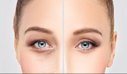 Laser Eyelid Rejuvenation - Non-surgical eyelid tightening treatment